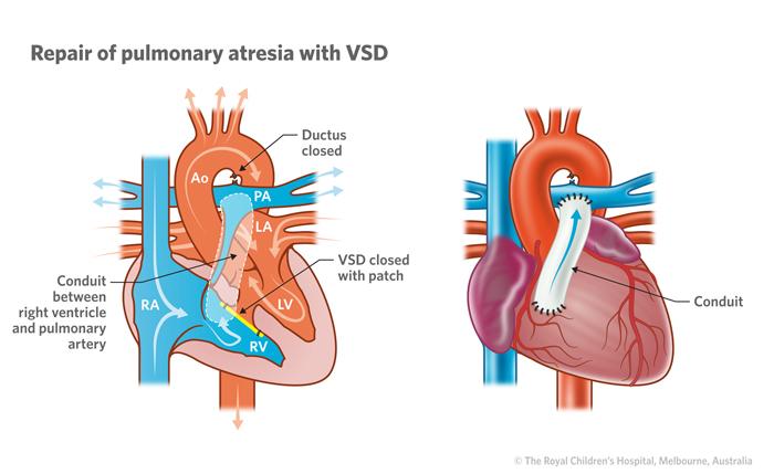 Pulmonary Atresia Surgery